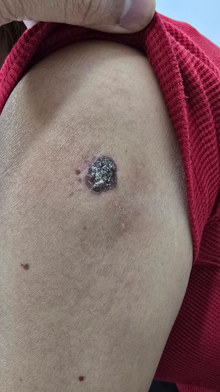 Bowen disease lesion close-up